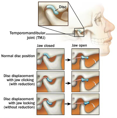 TMJ Joint Issues
